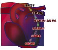 BECKMANCOULTER貝克曼庫爾特新一代預(yù)測心肌梗死試劑-Accu TnI